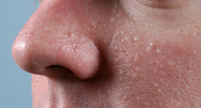 Skin fibrofolliculomas of patient with BHD. Small white/skin coloured bumps on the cheek  and nose. 